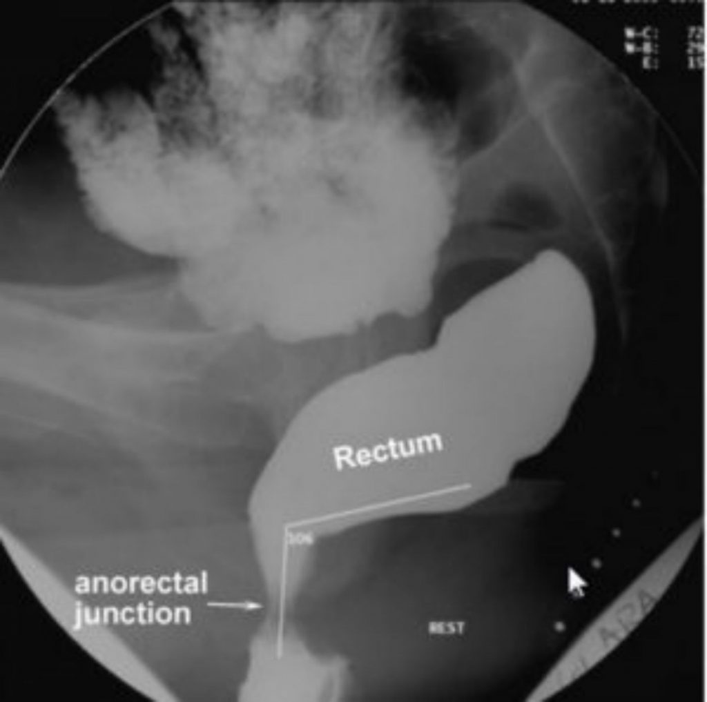 Accurate Differentiation of Dyssynergic Defecation Patients from Normal Subjects Based on Abnormal Anorectal Angle in MR Defecography